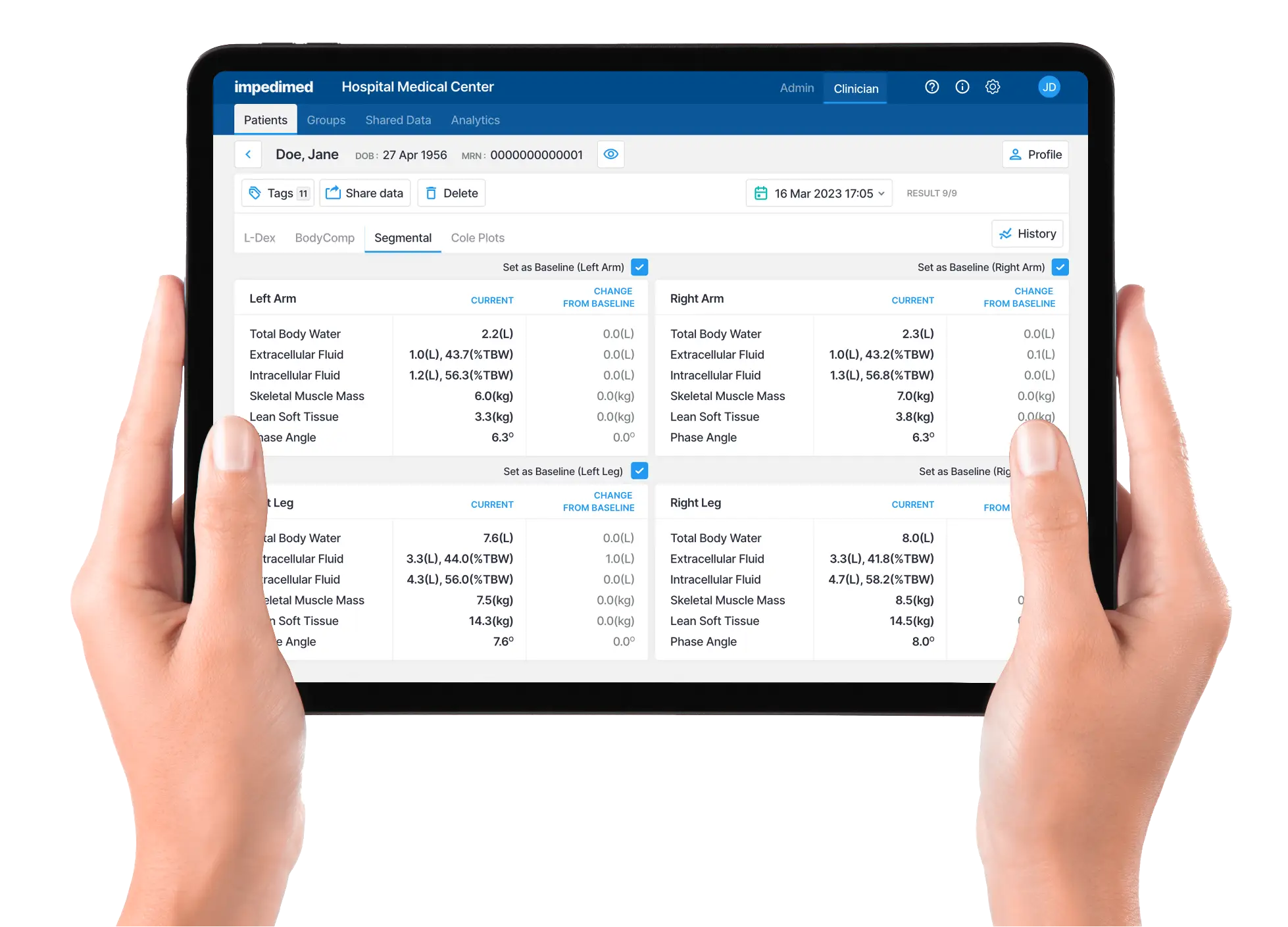 mission-2x | ImpediMed Tablet showing a hospital patient dashboard with segmented body metrics for left and right arms in a two-panel layout.